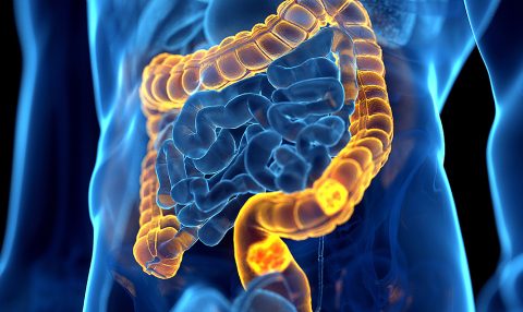 Análisis de la microbiota: un avance en la pesquisa del cáncer de colon
